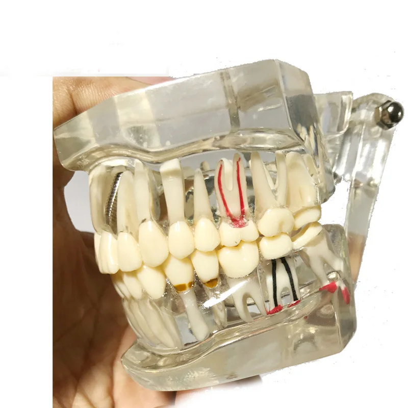 Diş Çalışma Diş Şeffaf Yetişkin Patolojik ve Hastalık Diş Modeli